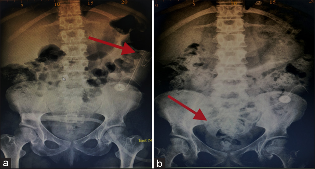 Compares two abdomen X-ray images pre and post catheter reposition for patient presented with continues alarm of low drain and low UF. It showed catheter migration and patient required surgical intervention for correction of PD Catheter position. (a) The red arrow in photo 1a shows that the PD catheter has migrated to the left upper quadrant of the abdomen and requires reposition. (b) The red arrow in photo 1b shows the PD catheter shadow in the pelvic region and it indicates that the catheter is back to the correct position after surgical intervention. UF: Ultrafiltration, PD: Peritoneal dialysis.